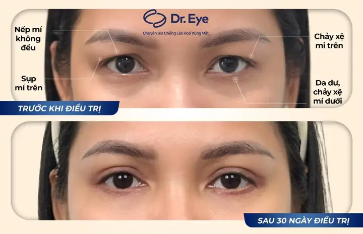 Cách Trị Nếp Nhăn Dưới Bọng Mắt