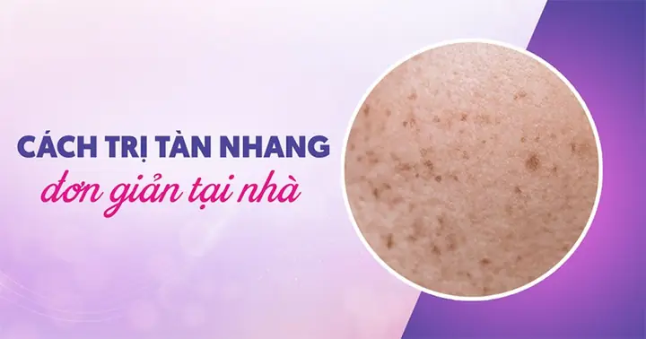 Cách Trị Tàn Nhang Tại Nhà Nhanh Và Hiệu Quả