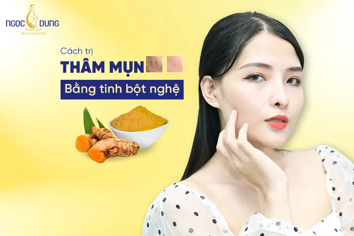 Cách Trị Thâm Bằng Bột Nghệ