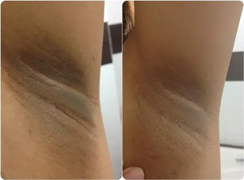 Cách Trị Thâm Sau Khi Sinh