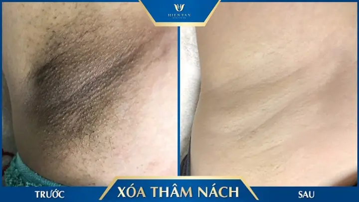 Cách Trị Thâm Sau Khi Sinh