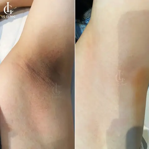 Cách Trị Thâm Và Triệt Lông Nách