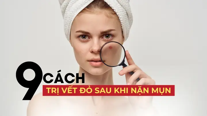 Cách Trị Vết Đỏ Sau Khi Nặn Mụn