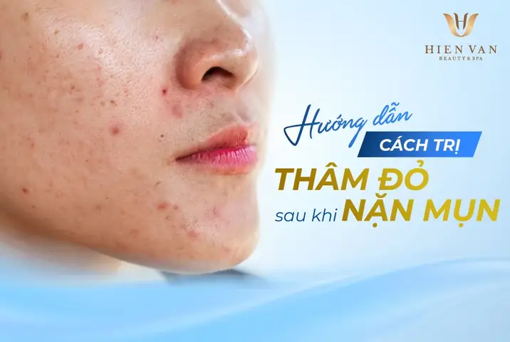 Cách Trị Vết Đỏ Sau Khi Nặn Mụn