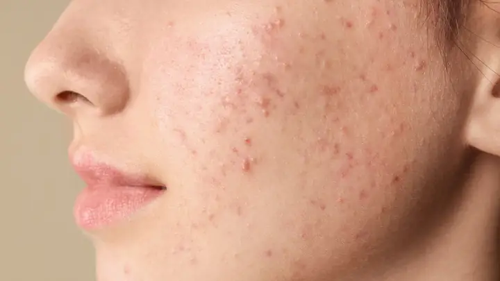 Cách Vệ Sinh Da Mặt Không Bị Mụn