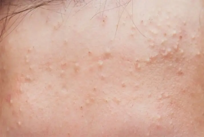 Cách Vệ Sinh Da Mặt Không Bị Mụn