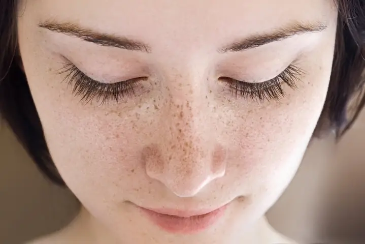 Cách Xóa Tàn Nhang Tự Nhiên
