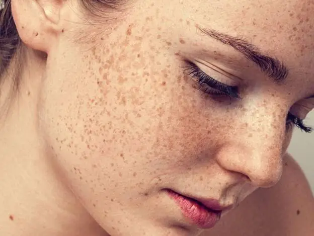 Cách Xóa Tàn Nhang Tự Nhiên