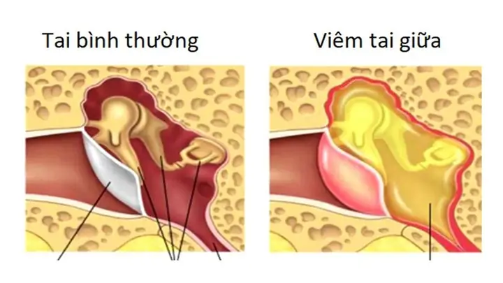 Cách Xử Lý Khi Nước Vào Tai Trẻ Sơ Sinh