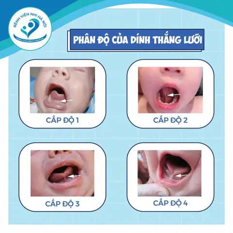 Cắt Thắng Lưỡi Bệnh Viện Nhi Đồng 1