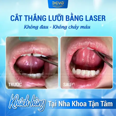 Cắt Thắng Lưỡi Cho Bé Bao Nhiêu Tiền