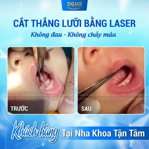 Cắt Thắng Lưỡi Cho Bé Bao Nhiêu Tiền