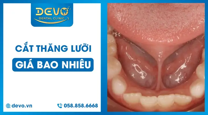 Cắt Thắng Lưỡi Cho Bé Bao Nhiêu Tiền