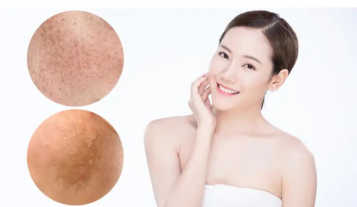 Chăm Sóc Da Mặt Bị Nám Tàn Nhang