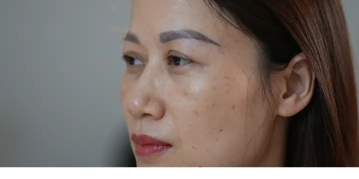 Chăm Sóc Da Mặt Bị Nám Tàn Nhang