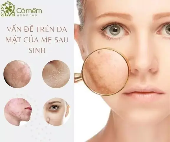 Chăm Sóc Da Mặt Sau Sinh Bằng Dầu Dừa