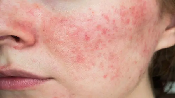 Chăm Sóc Da Sau Dị Ứng