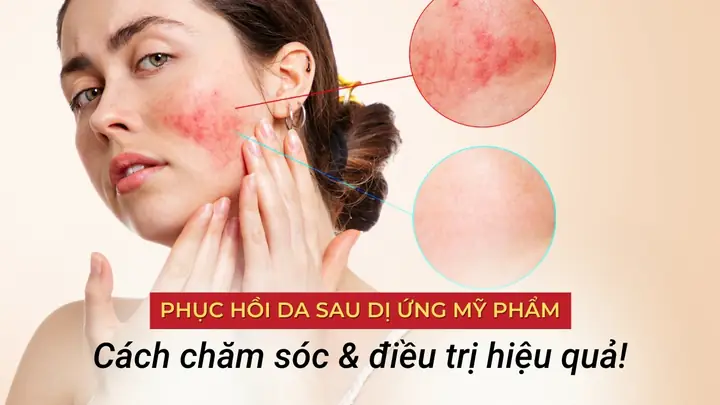 Chăm Sóc Da Sau Dị Ứng