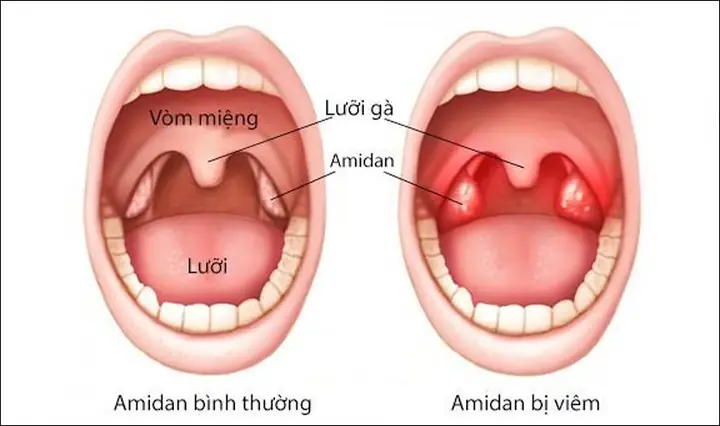 Chi Phí Cắt Amidan Cho Trẻ