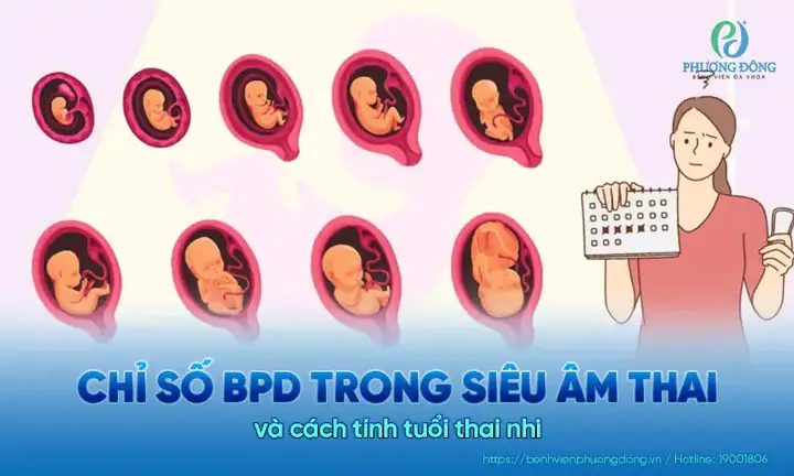 Chỉ Số Bpd Trong Siêu Âm Thai