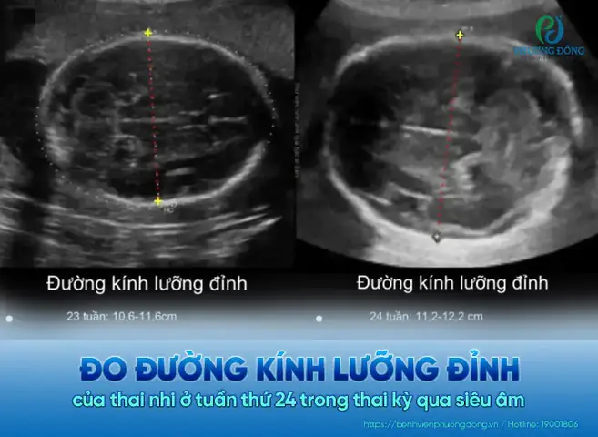 Chỉ Số Bpd Trong Siêu Âm Thai