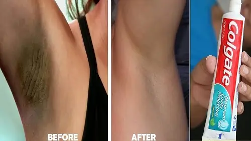 Chữa Hôi Nách Bằng Kem Đánh Răng