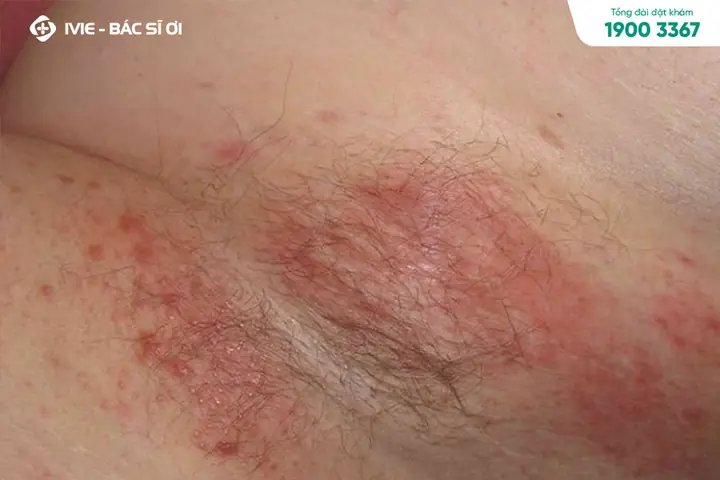 Chữa Nấm Da Ở Trẻ Sơ Sinh