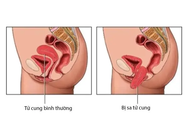 Co Dạ Con Sau Sinh Thường