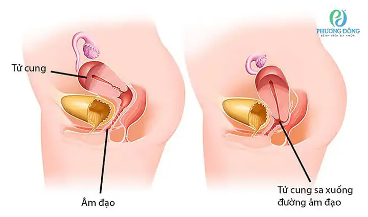 Co Dạ Con Sau Sinh Thường