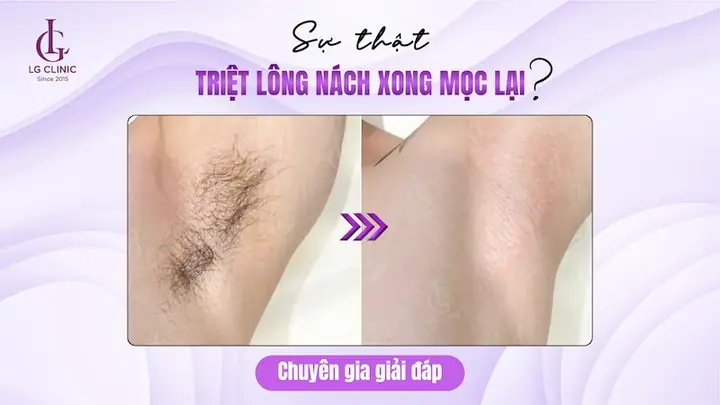Có Mẹ Nào Triệt Lông Vĩnh Viễn Chưa