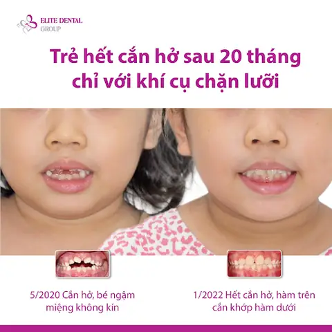 Có Nên Cho Trẻ Mút Tay