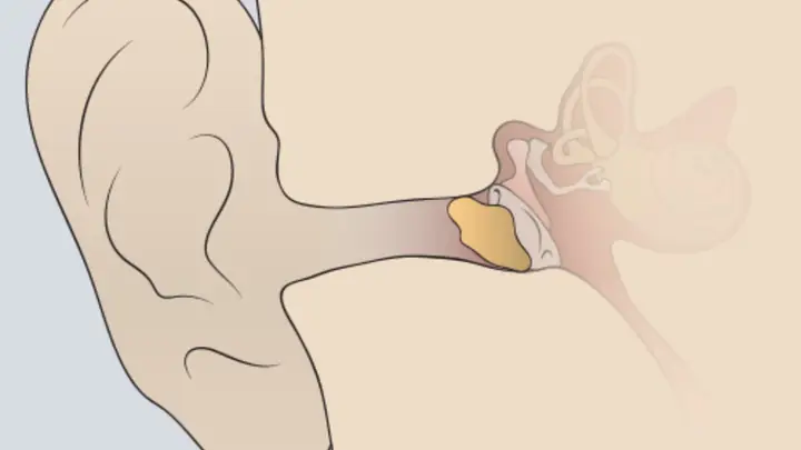 Có Nên Lấy Ráy Tai Cho Trẻ 3 Tháng Tuổi