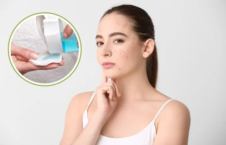 Da Bị Mụn Có Nên Dùng Toner Không