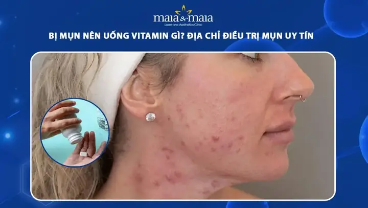 Da Bị Mụn Nên Uống Vitamin Gì