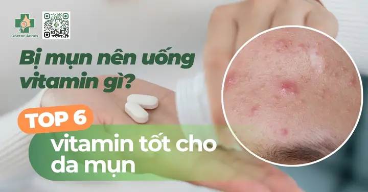 Da Bị Mụn Nên Uống Vitamin Gì