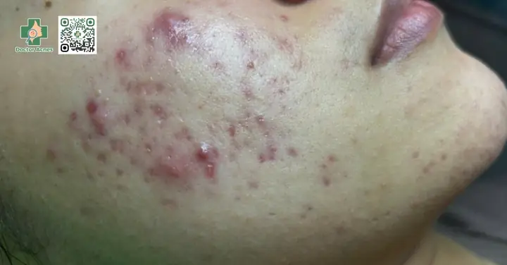 Da Bị Mụn Nên Uống Vitamin Gì