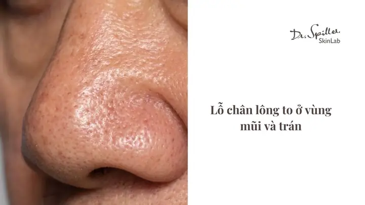 Da Dầu Nên Đắp Mặt Nạ Gì