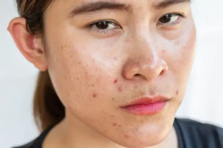 Da Dầu Nên Dùng Mặt Nạ Gì