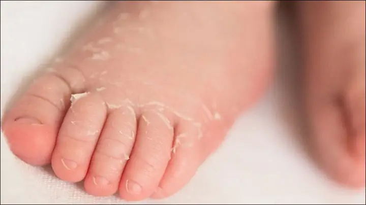 Da Em Bé Sơ Sinh Bị Khô