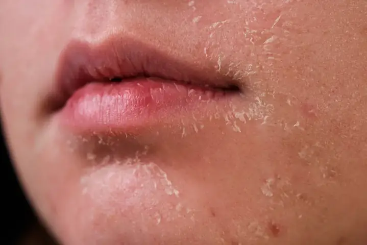 Da Mặt Khô Nên Dùng Kem Gì