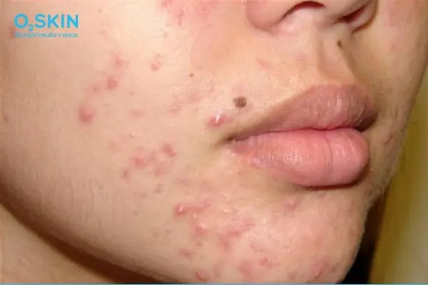 Da Mụn Có Nên Tẩy Tế Bào Chết Không
