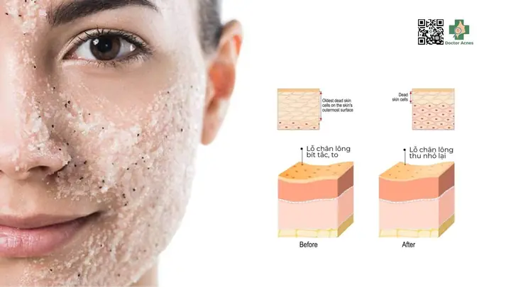 Da Mụn Có Nên Tẩy Tế Bào Chết Không
