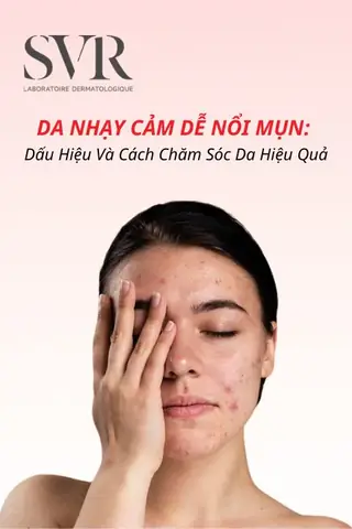 Da Nhạy Cảm Dễ Nổi Mụn