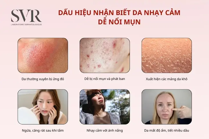 Da Nhạy Cảm Dễ Nổi Mụn
