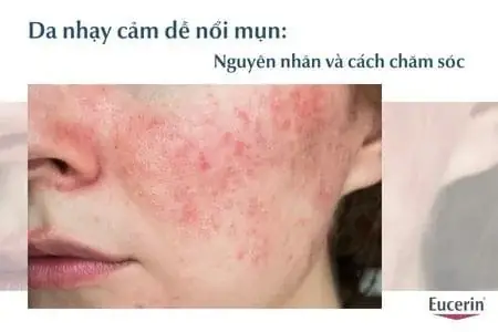 Da Nhạy Cảm Dễ Nổi Mụn