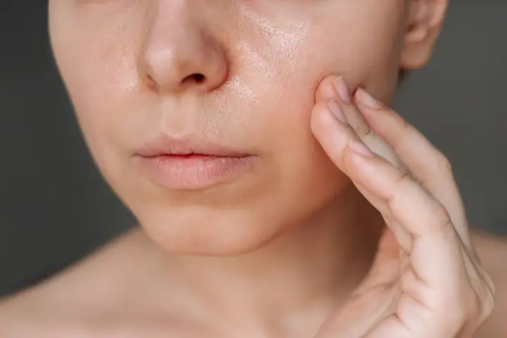 Da Nhờn Có Nên Dưỡng Ẩm