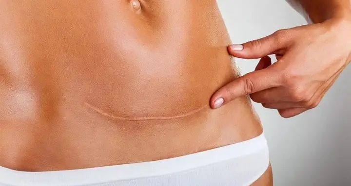 Đai Nịt Bụng Sau Sinh Mổ