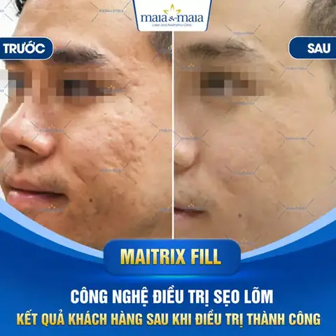 Đắp Mặt Nạ Trị Sẹo Rỗ