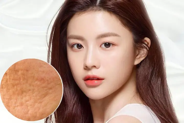 Đắp Mặt Nạ Trị Sẹo Rỗ