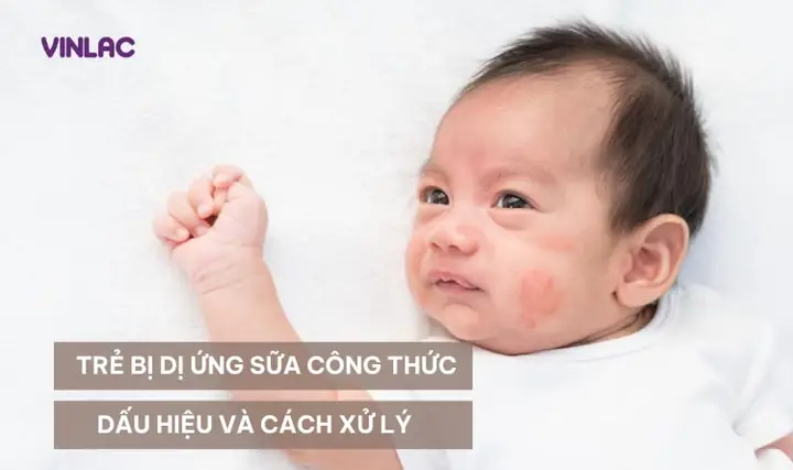 Dấu Hiệu Bé Dị Ứng Sữa Mẹ